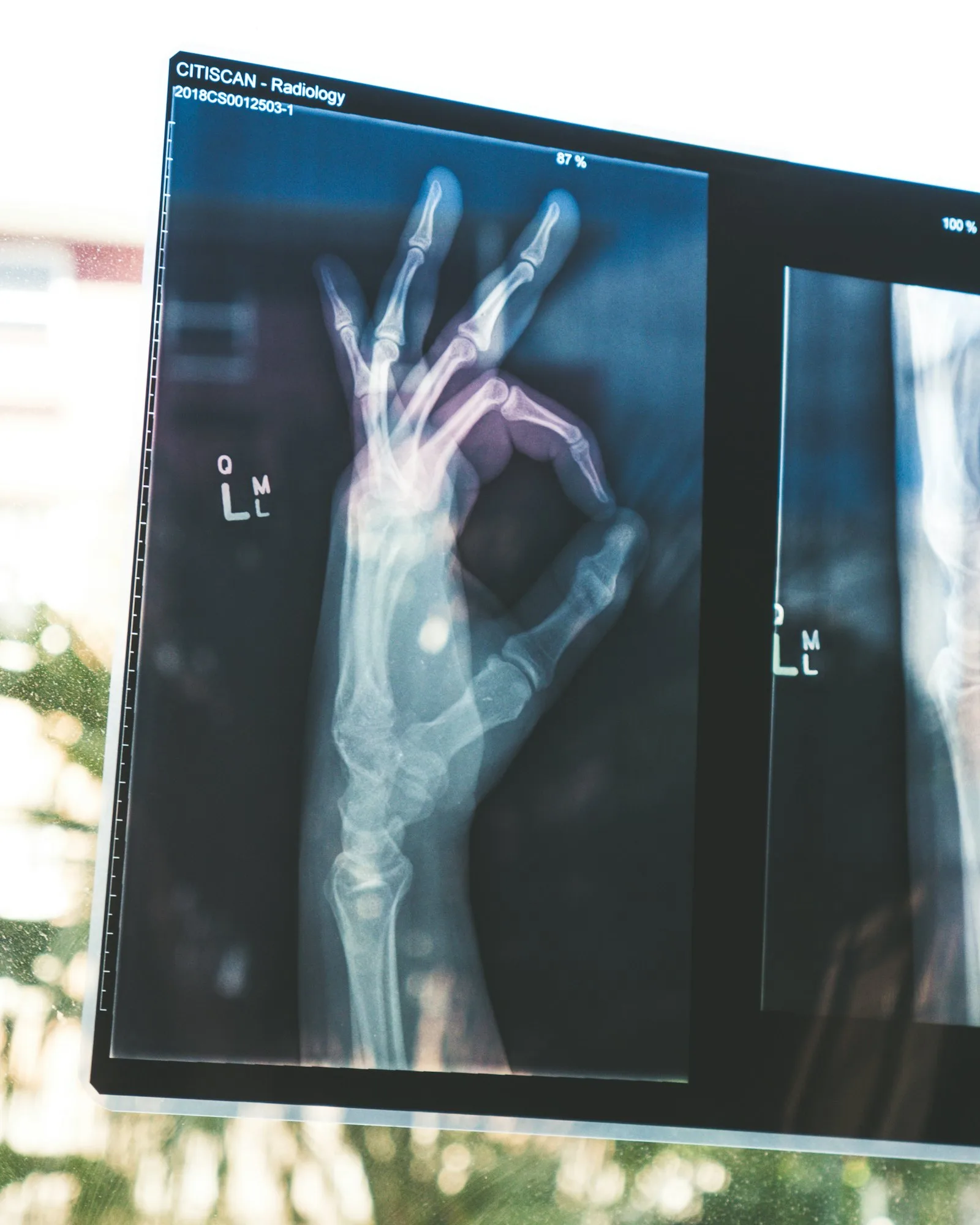 Digital X-ray displayed on a viewer
